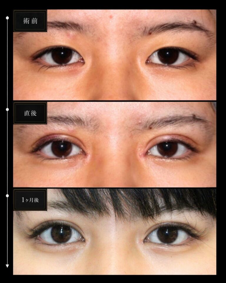 術後経過 二重切開＋目頭切開症例・術前と術後の代表比較｜CASE 72