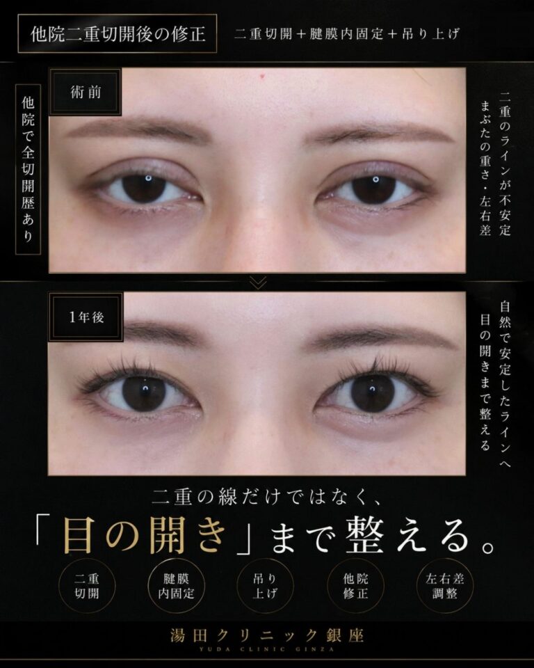 食い込みの強い不自然な幅広二重を狭く修正CaseI135