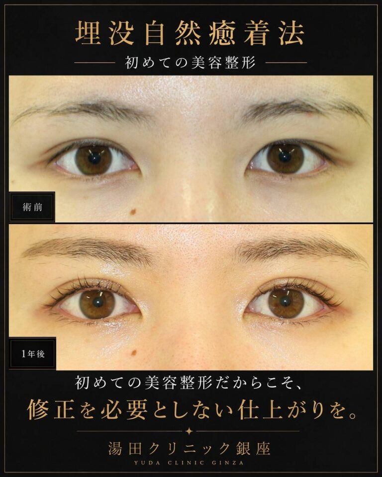 厚ぼったい瞼。二重幅を広くパッチリ二重にしたいCASE B 004