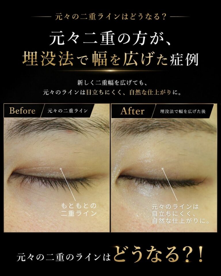 厚ぼったい瞼。二重幅を広くパッチリ二重にしたいCASE B 004
