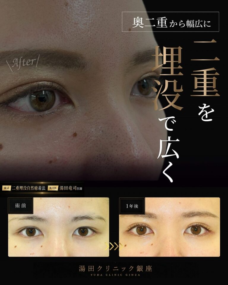 厚ぼったい瞼。二重幅を広くパッチリ二重にしたいCASE B 004