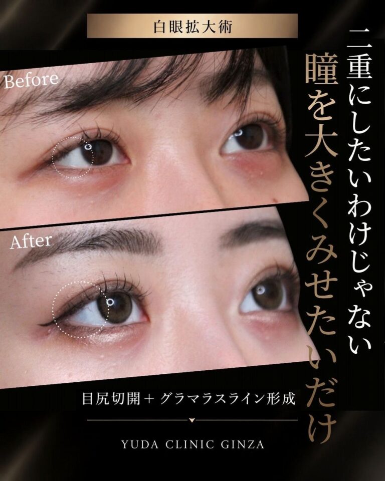 白目拡大手術（目尻切開 グラマラスライン形成）症例・術前と術後の代表比較｜CASE 66